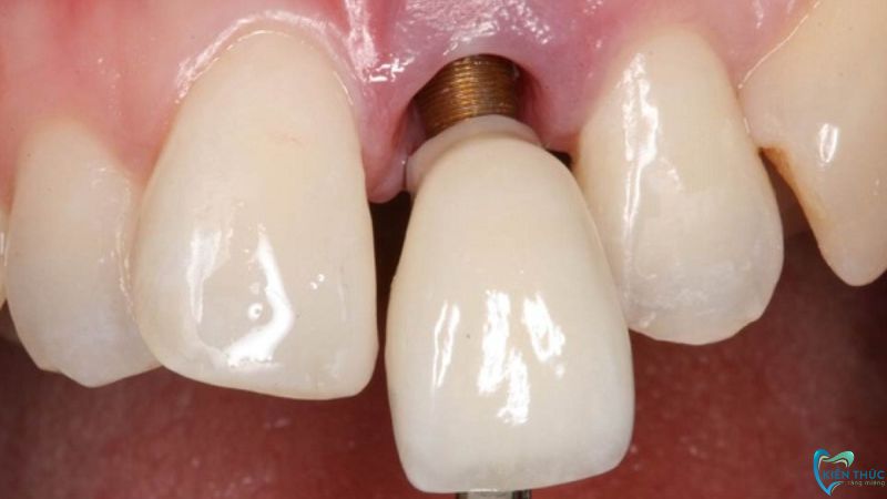 trồng răng Implant giá rẻ