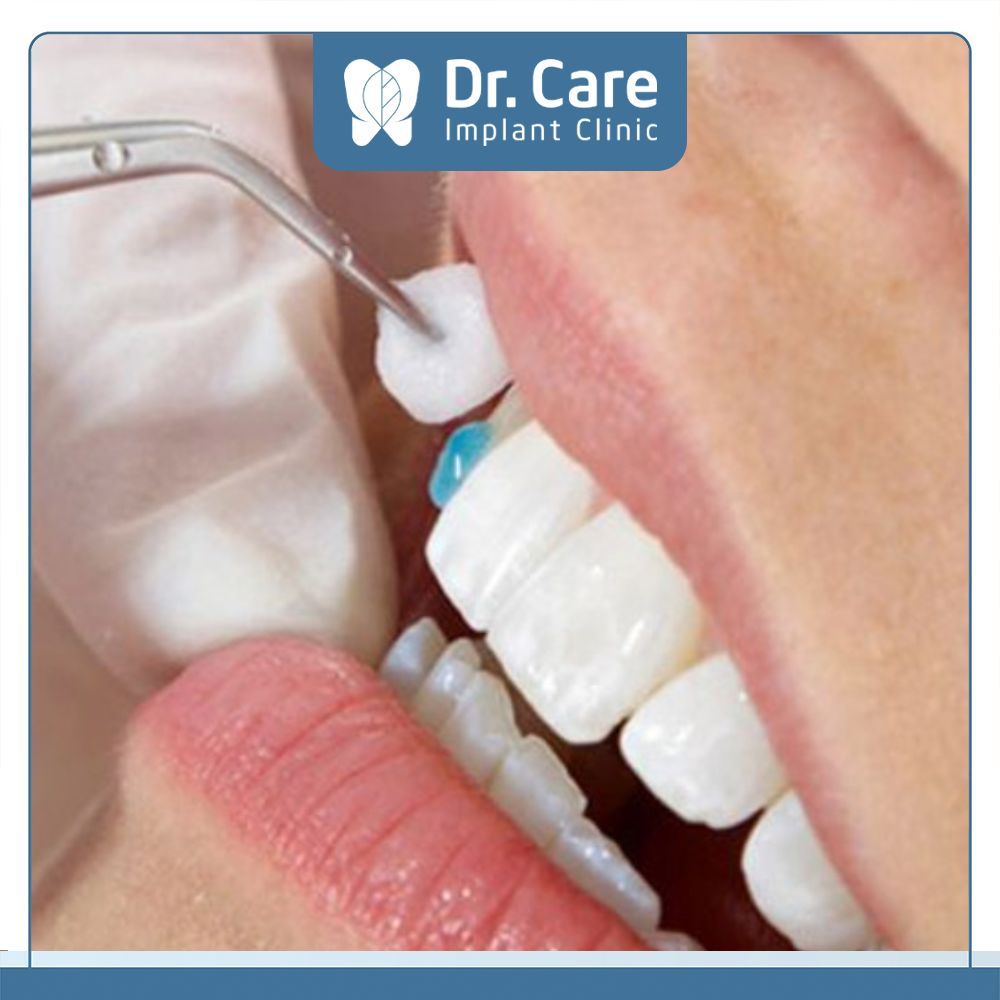 Keo dán răng sứ là vật liệu chuyên dụng trong nha khoa để kết nối cùi răng thật và mão răng sứ