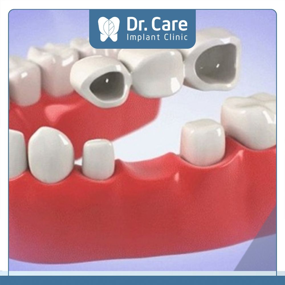 Phương pháp trồng răng giả cố định như bọc răng sứ, làm cầu răng cần chất keo dán răng sứ cố định để kết nối chắc chắn và có tuổi thọ cao