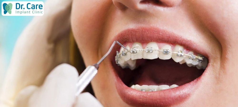Bọc răng sứ nhanh chóng lấy lại hàm răng đẹp nhưng về mức độ mặt lệch bên phải thì chưa khắc phục được tốt