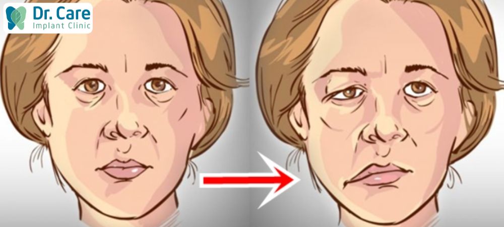 Hậu quả của việc nhai một bên là gương mặt bị biến dạng bên to bên nhỏ, lệch sang trái hoặc sang phải