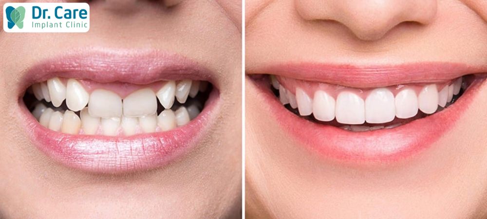 Bọc răng sứ nhanh chóng lấy lại hàm răng đẹp nhưng về mức độ mặt lệch bên phải thì chưa khắc phục được tốt