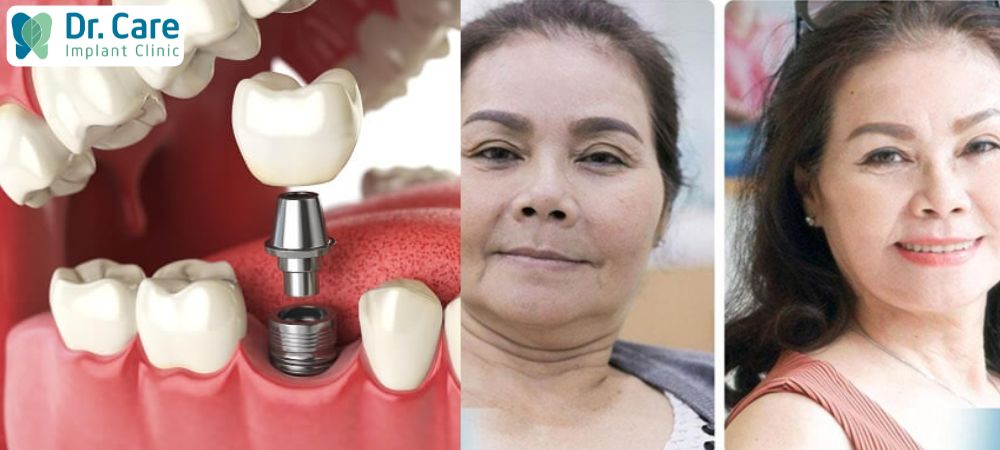  Mất răng lâu năm gây lệch hàm, mặt lệch bên phải nghiêm trọng thì vẫn có thể trồng răng Implant nhưng cần kiểm tra, ghép xương nếu cần thiết