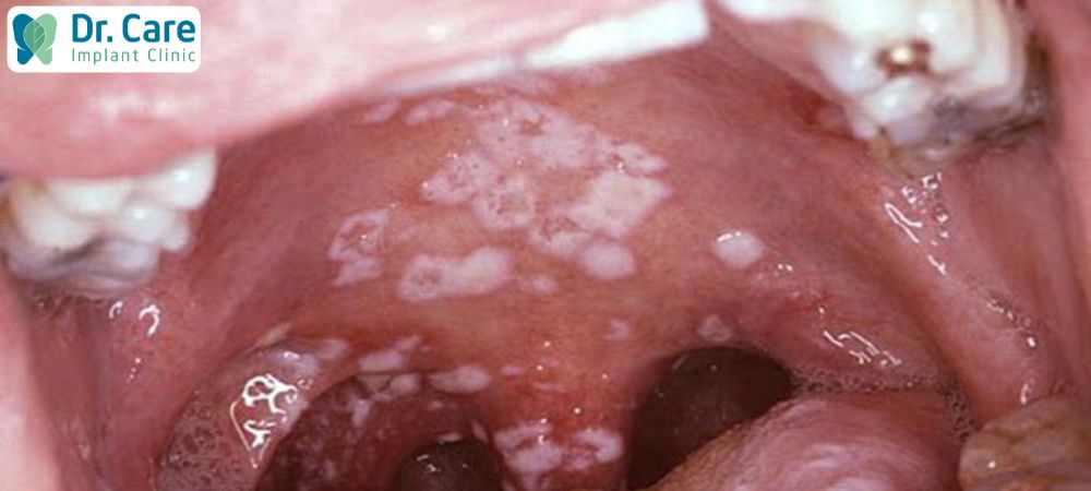 Viêm họng do nhiễm nấm sẽ gây đau đớn, nuốt nước bọt đau rát, khó chịu