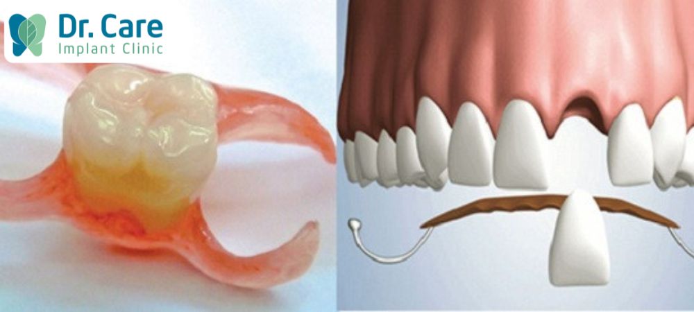 Răng giả tháo lắp 1 chiếc được cấu thành từ 2 bộ phận chính là khung và răng