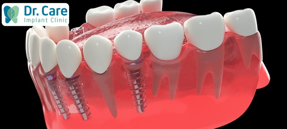 Trồng răng Implant thay thế một vài răng đảm bảo độ thẩm mỹ, hài hòa về màu sắc lẫn kích thước so đem lại độ tự nhiên