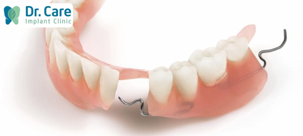 Răng giả tháo lắp 1 cái làm bằng khung kim loại giúp cố định răng giả tháo lắp hơn so với toàn nhựa dẻo