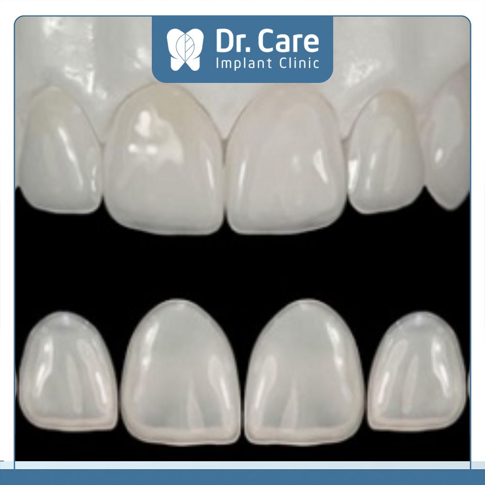 Răng sứ Emax là dòng sứ được sản xuất 100% từ vật liệu thủy tinh Lithium Disilicate