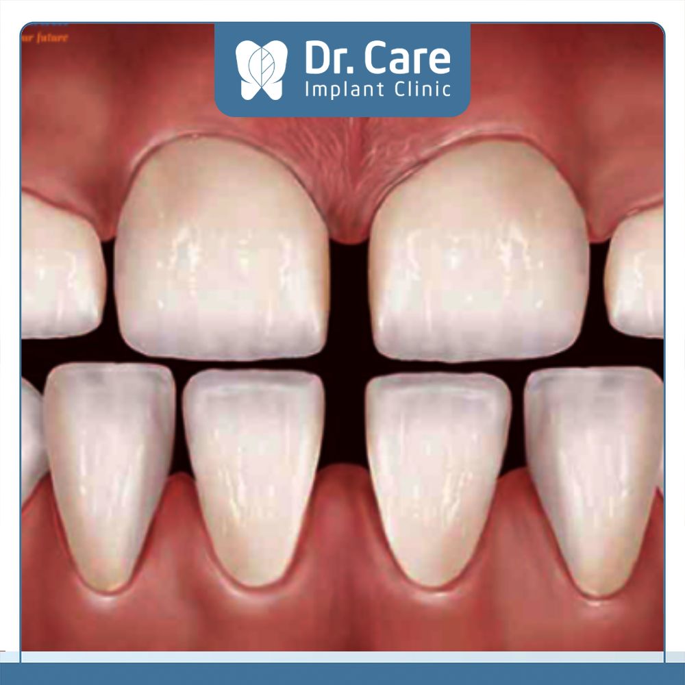 Trường hợp nên sử dụng răng sứ Emax là khi tính thẩm mỹ của răng bị sụt giảm do bị thưa, kẽ hở lớn