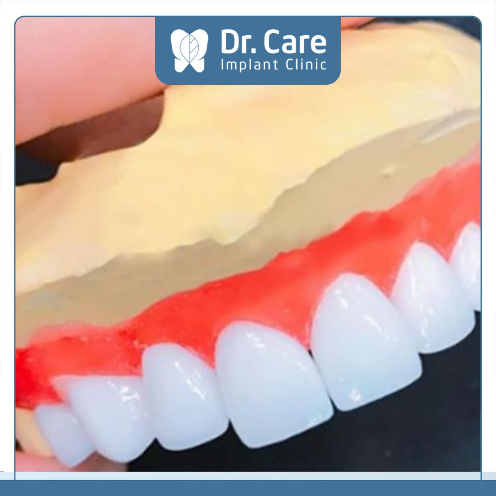 Răng sứ HT Smile có thiết kế dày nên khả năng xâm lấn vào cấu trúc răng nhiều hơn