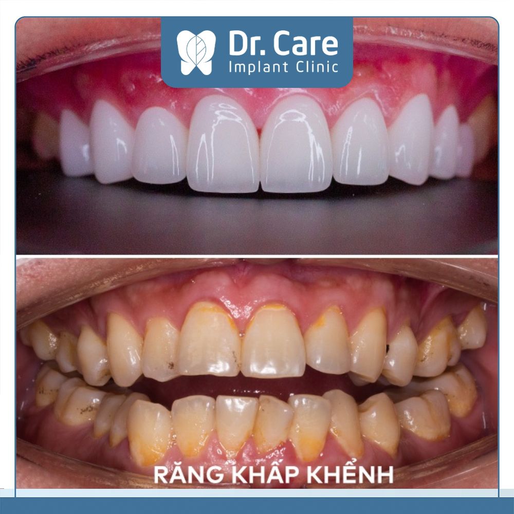  Bọc răng sứ HT Smile răng khấp khểnh, bị ngả vàng nghiêm trọng và có nhu cầu làm trắng răng, răng thẩm mỹ