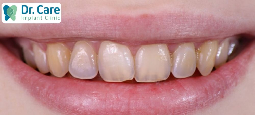 Răng sâu lâu này sẽ làm lớp men răng mòn, nhạy cảm hơn khi ăn thức ăn nóng lạnh