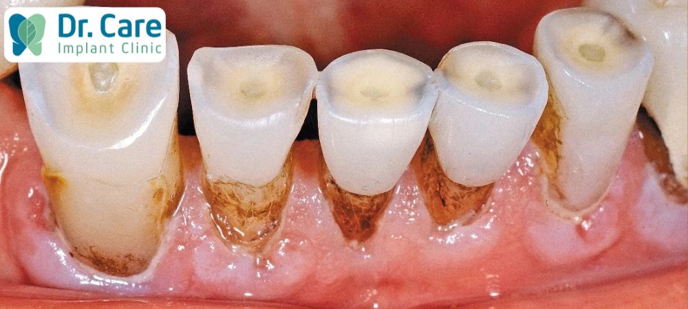 Sâu răng sẽ xuất hiện các lỗ sâu với kích thước lớn làm phần ngà răng ảnh hưởng nặng nề