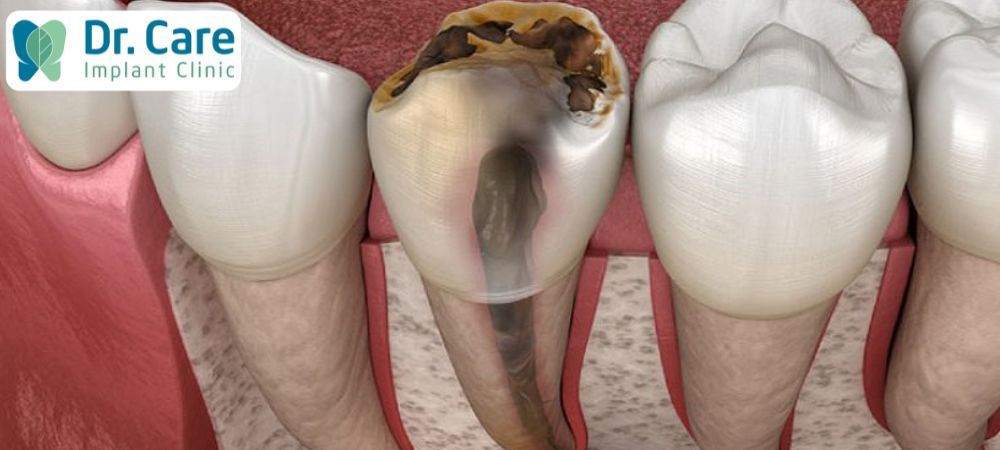 Tủy răng bị ảnh hưởng là mối lo ngại lớn đối với sức khỏe răng miệng của Cô Chú, Anh Chị