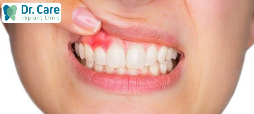 Sâu răng để lâu ngày sẽ gây ảnh hưởng đến sức khỏe răng miệng, dẫn đến bệnh viêm nha chu nguy hiểm 
