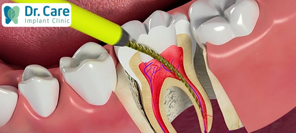 Hình 7: Giai đoạn sâu răng ăn vào tủy là giai đoạn nguy hiểm nhất cần điều trị kịp thời