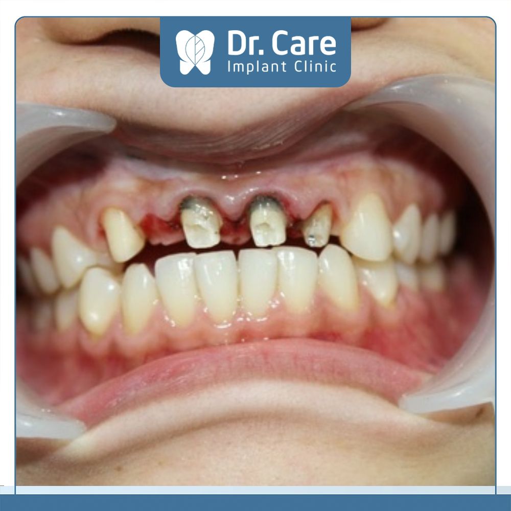 Hậu quả và sai lầm khi bọc răng sứ giá rẻ, sai kỹ thuật là gây sâu răng, tổn thương trong khoang miệng