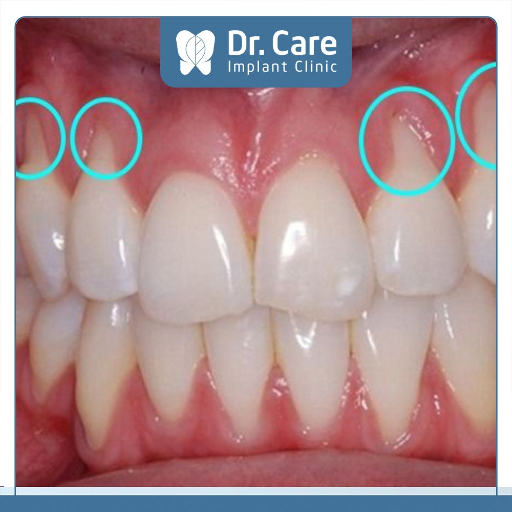 Kỹ thuật bọc răng sứ của bác sĩ sai cách, không đảm bảo gây xâm lấn răng thật, gây ra tình trạng viêm lợi, tụt chân răng 