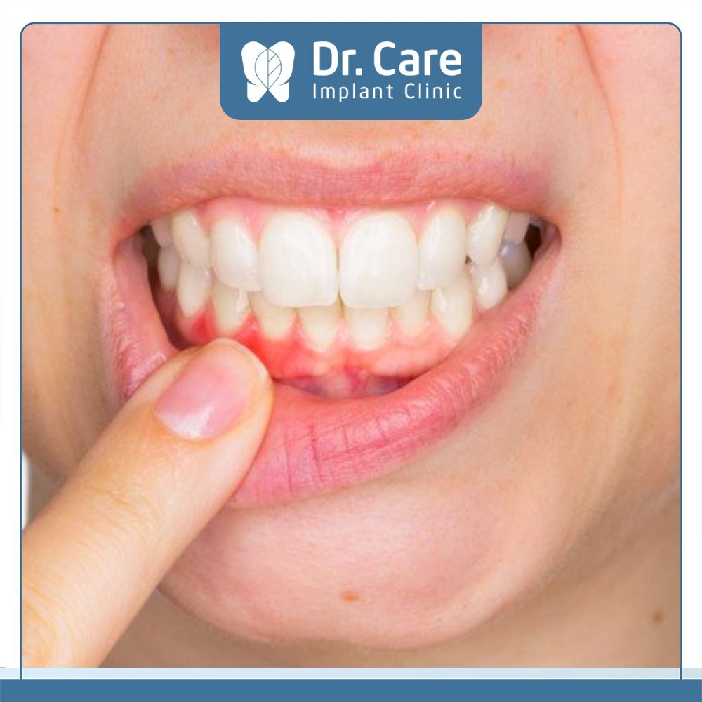Nếu mắc phải các bệnh lý như viêm nướu thì cần thêm chi phí điều trị trước khi trồng răng hàm để đảm bảo điều kiện an toàn, tránh các biến chứng xảy ra