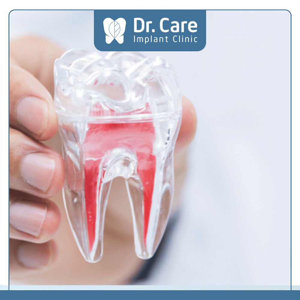 Nếu Cô Chú, Anh Chị đang bị viêm tủy răng thì cần thêm chi phí điều trị tủy trước khi trồng răng