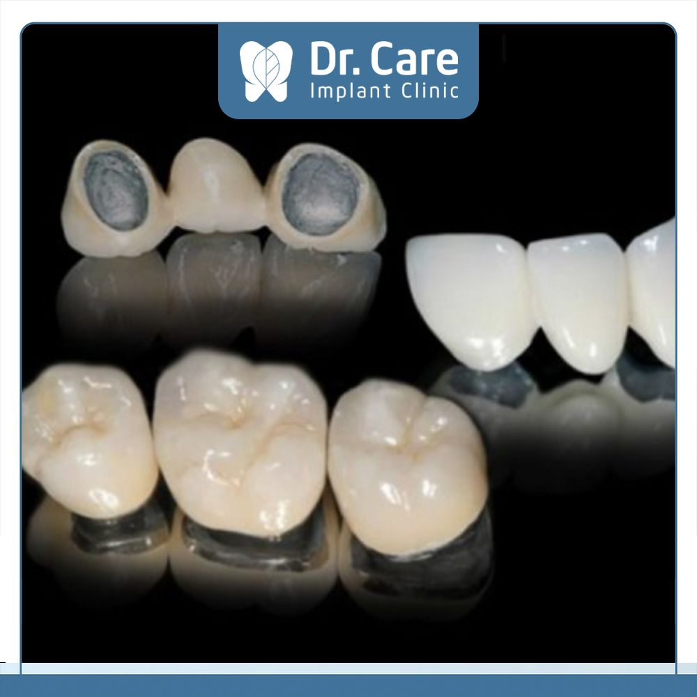 Răng sứ kim loại chỉ sử dụng từ 5 – 7 năm nên cần thay lại răng sứ mới để đảm bảo tính thẩm mỹ