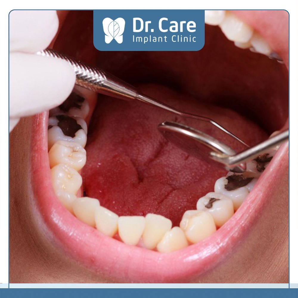 Mức độ sâu răng và số lượng răng sâu cũng làm chênh lệch chi phí trồng răng hàm bị sâu của Cô Chú, Anh Chị