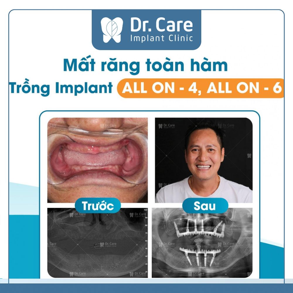 Đối với các phương pháp hiện đại như Implant thì mức chi phí Cô Chú, Anh Chị bỏ ra sẽ cao hơn so với các phương pháp khác