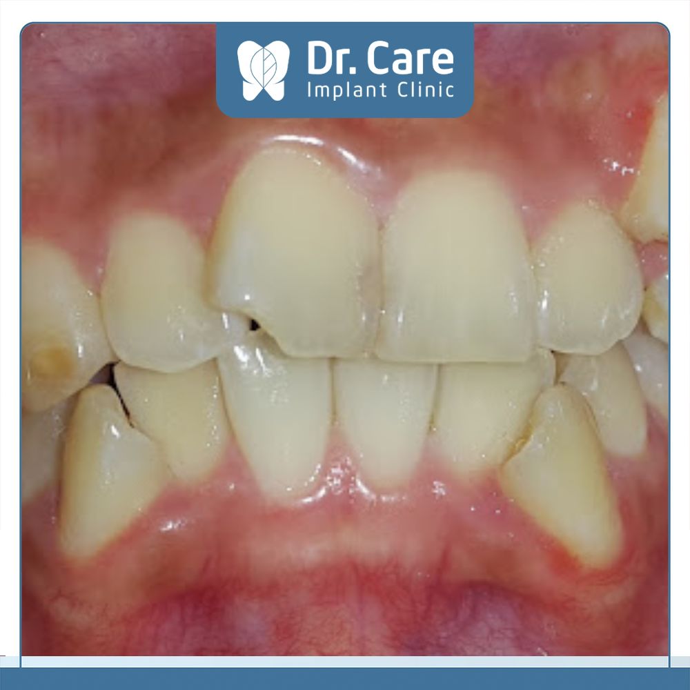 Trường hợp răng lệch lạc quá nhiều cần lấy tủy trước khi trồng răng sứ