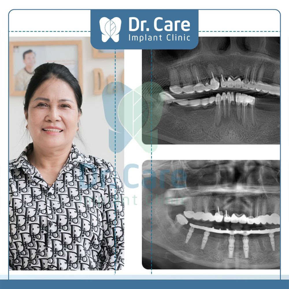 Cấy ghép Implant là phương pháp trồng răng hàm bị sâu tối ưu và ngăn chặn tình trạng tiêu xương xảy ra ảnh hưởng sức khỏe