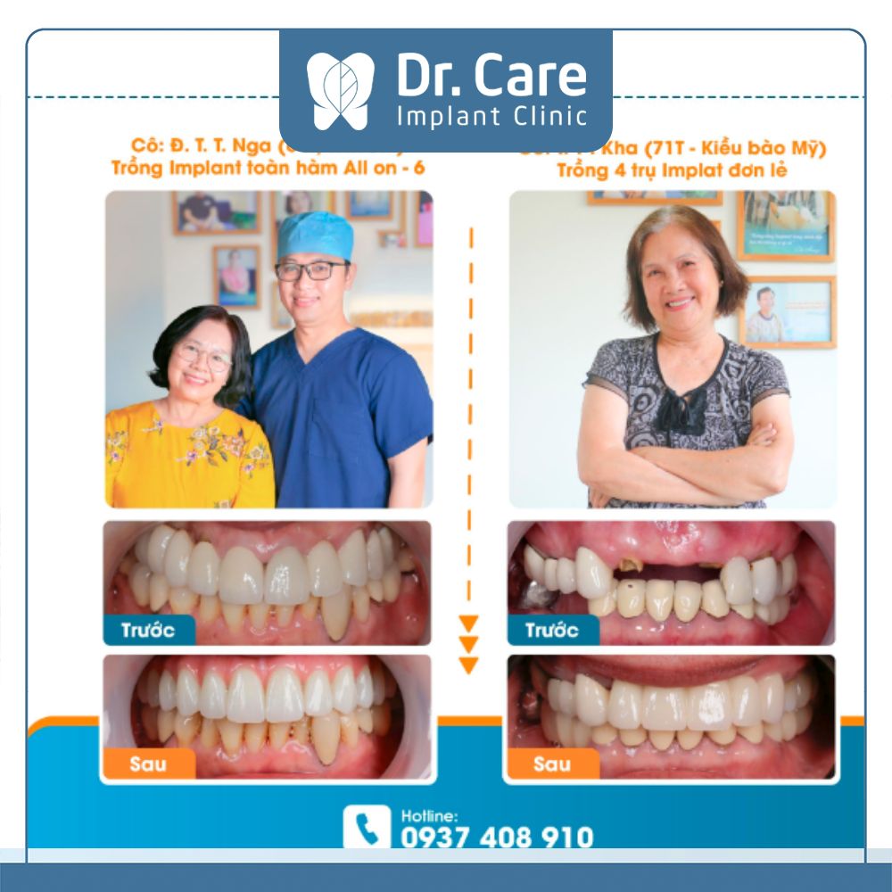 Phương pháp trồng răng Implant có chi phí điều trị cao hơn so với các phương pháp còn lại, chi phí trồng răng Implant đơn lẻ dao động từ 15.000.000 VNĐ - 36.500.000 VNĐ