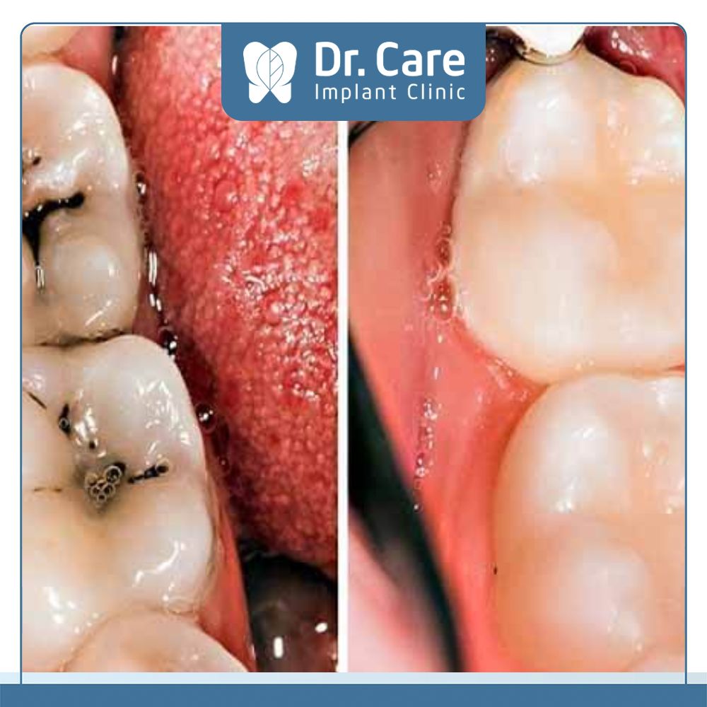 Răng bị sâu có thể bọc răng sứ để khôi phục chức năng ăn nhai và tính thẩm mỹ