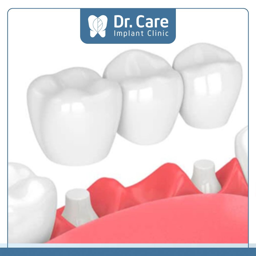  Cầu răng sứ là một trong các phương pháp trồng răng hàm bị sâu giúp khôi phục khả năng ăn nhai và tăng thẩm mỹ