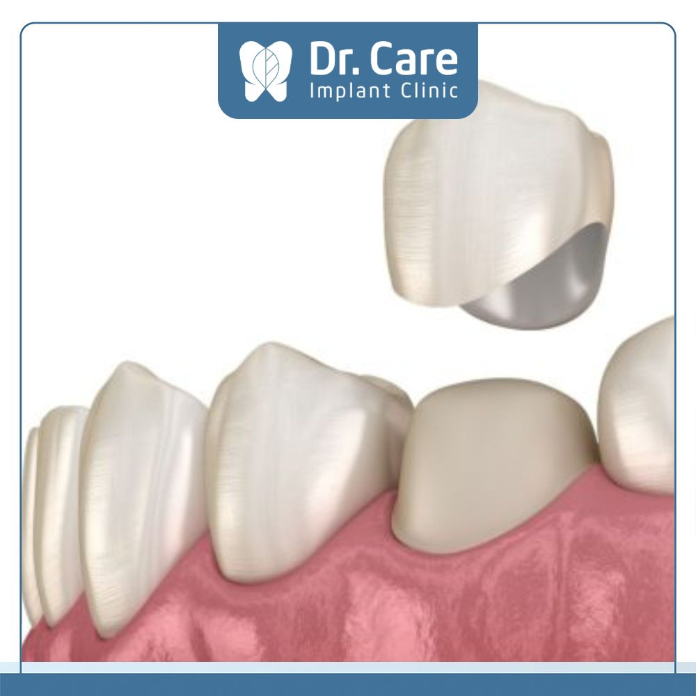 Bọc răng sứ là phương pháp điều trị khi răng hàm bị sâu có sự đánh giá cao về tính phục hình và độ thẩm mỹ