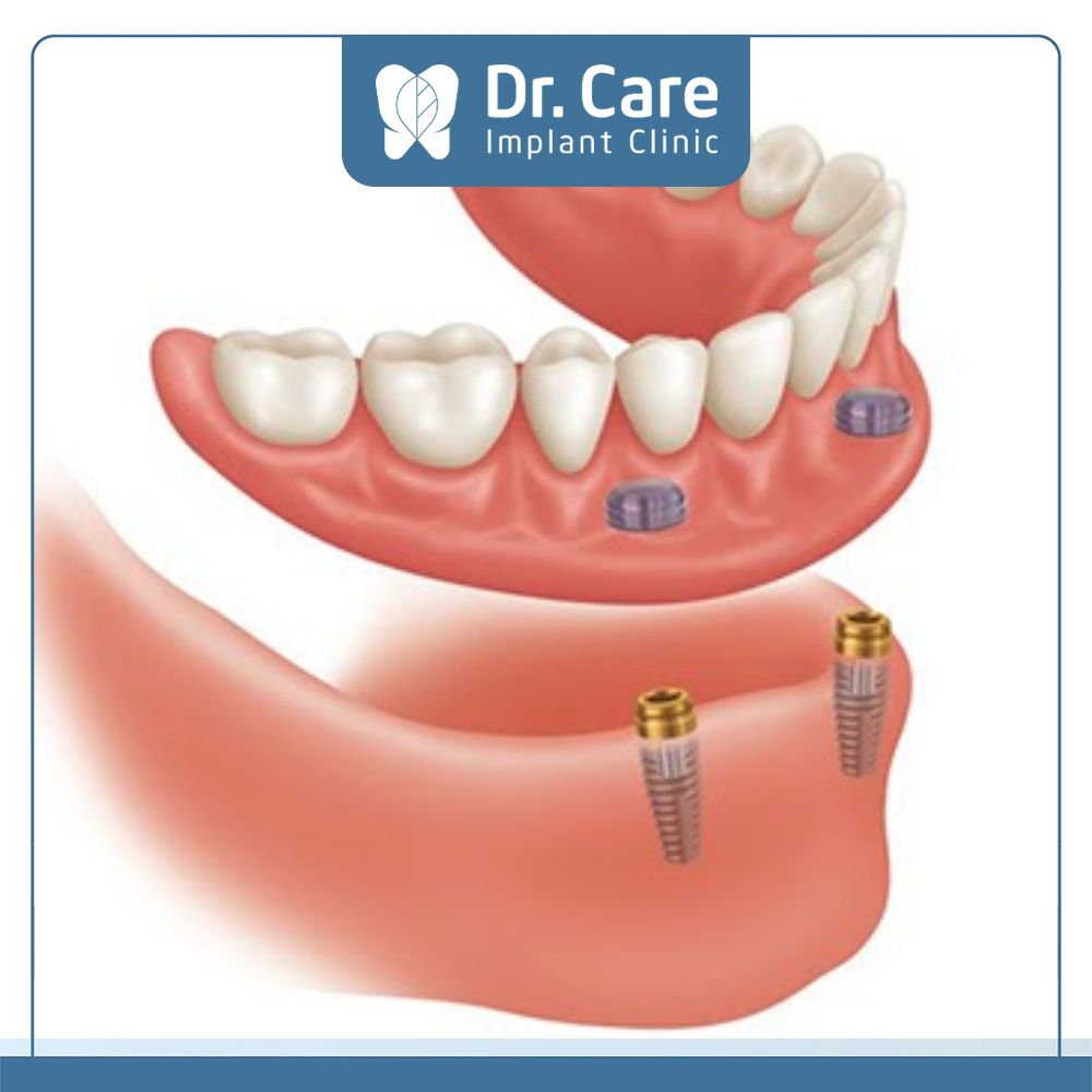 Sử dụng hàm phủ trên Implant khi răng bị sâu cũng khắc phục được tính thẩm mỹ cho Cô Chú, Anh Chị
