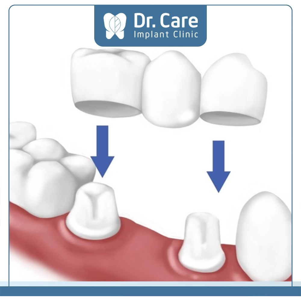 Phương pháp trồng răng bắc cầu khắc phục tình trạng mất răng cố định bằng việc mài 2 răng thật kề bên vị trí mất răng