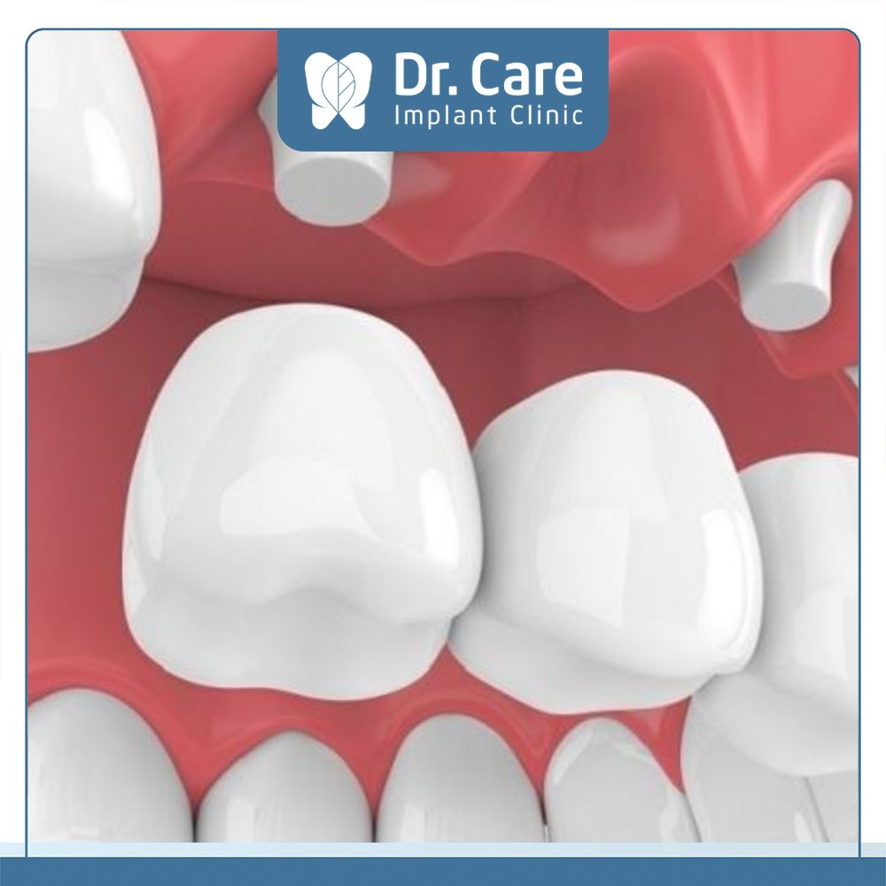 Phương pháp làm cầu răng sứ chỉ phù hợp với đối tượng mất một hoặc vài chiếc răng, đồng thời 2 răng ở vị trí kế bên răng mất còn chắc khỏe