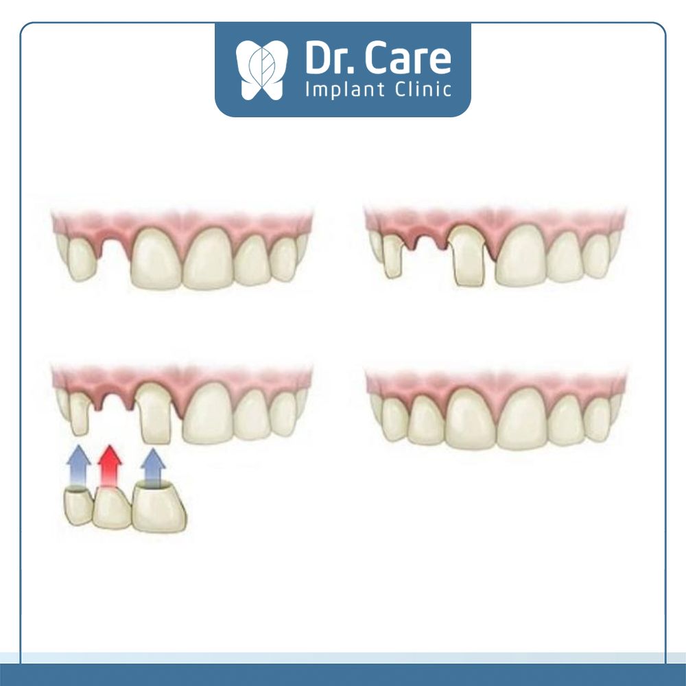 Cầu răng sứ truyền thống là phương pháp sử dụng 2 răng chắc khỏe bên cạnh khoảng mất răng để làm trụ đỡ