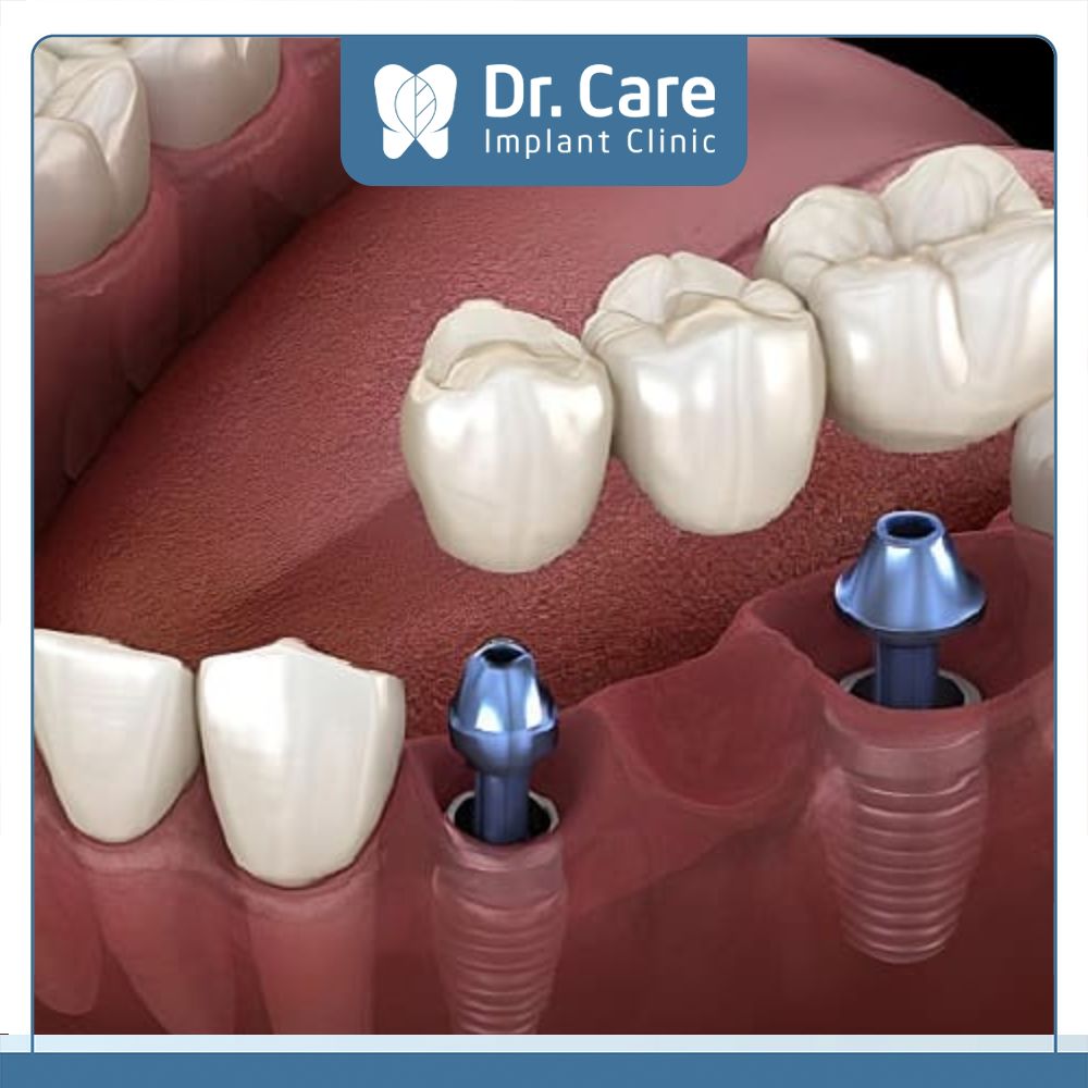 Cầu răng sứ được hỗ trợ Implant là phương pháp tiên tiến và phù hợp trong trường hợp mất răng nhiều năm ở các vị trí liền kề