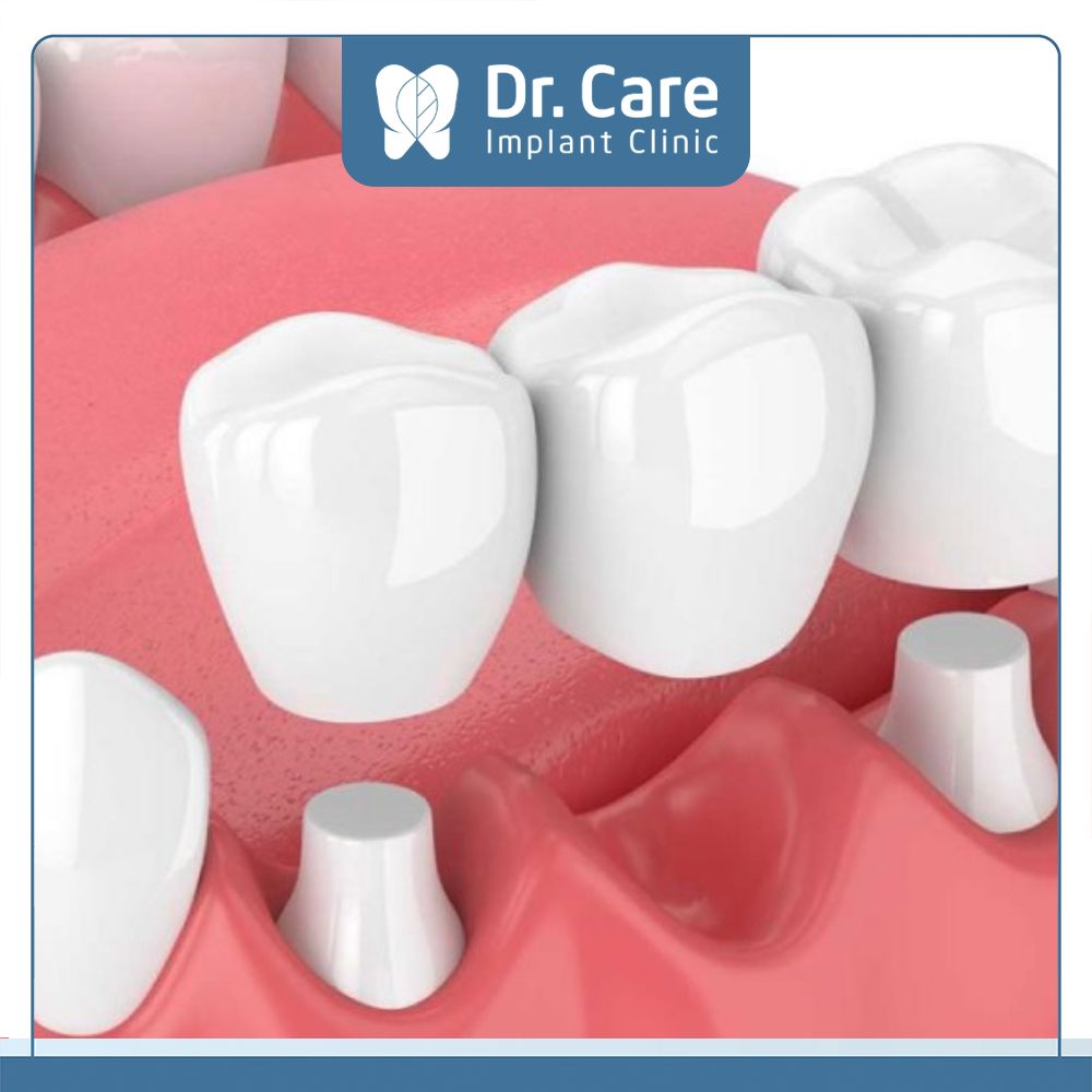 Cầu răng sứ rất an toàn, không gây kích ứng với các tổ chức trong khoang miệng nhờ chất liệu lành tính, an toàn