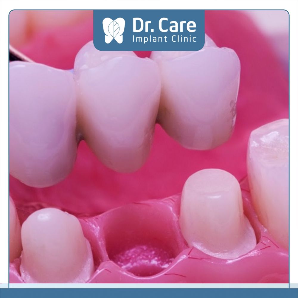 Cầu răng sứ còn có hạn chế là giới hạn trong những trường hợp mất răng nhiều hoặc mất răng khoảng rộng