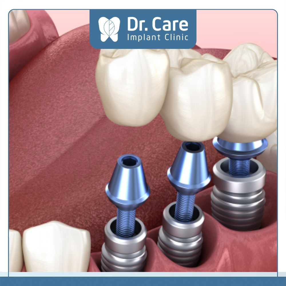 Cấy ghép Implant chỉ tác động tại vùng mất răng và không phải mài 2 răng thật kế cận để làm trụ, gây ảnh hưởng đến răng kế cận. 