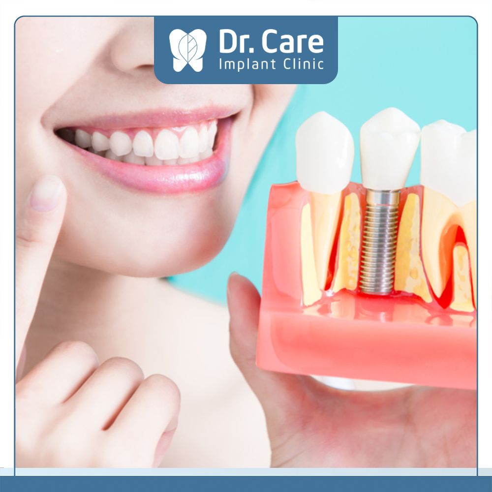 Nếu sau khi làm cầu răng sứ bị tiêu xương thì cách tốt nhất để ngăn chặn tình trạng này là trồng răng Implant