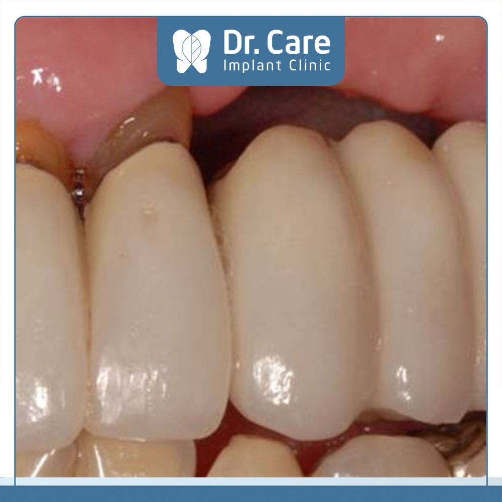 Khi mài răng quá mức sẽ khiến tổ chức tủy răng bị kích thích gây viêm tủy, thậm chí là gây mất răng vĩnh viễn