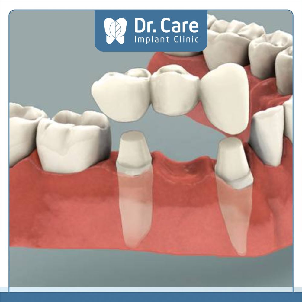 Cầu răng sứ có mức độ xâm lấn cao, trên thực tế việc phục hình một răng sẽ phải tác động đến hai răng thật liền kề bên cạnh