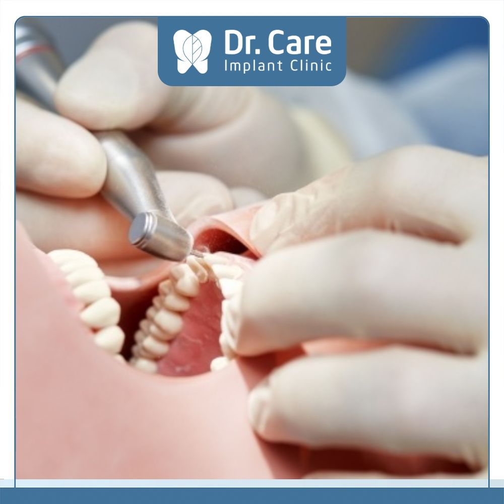 Tay nghề, trình độ của các Bác sĩ sẽ quyết định đến tuổi thọ của cầu răng sứ