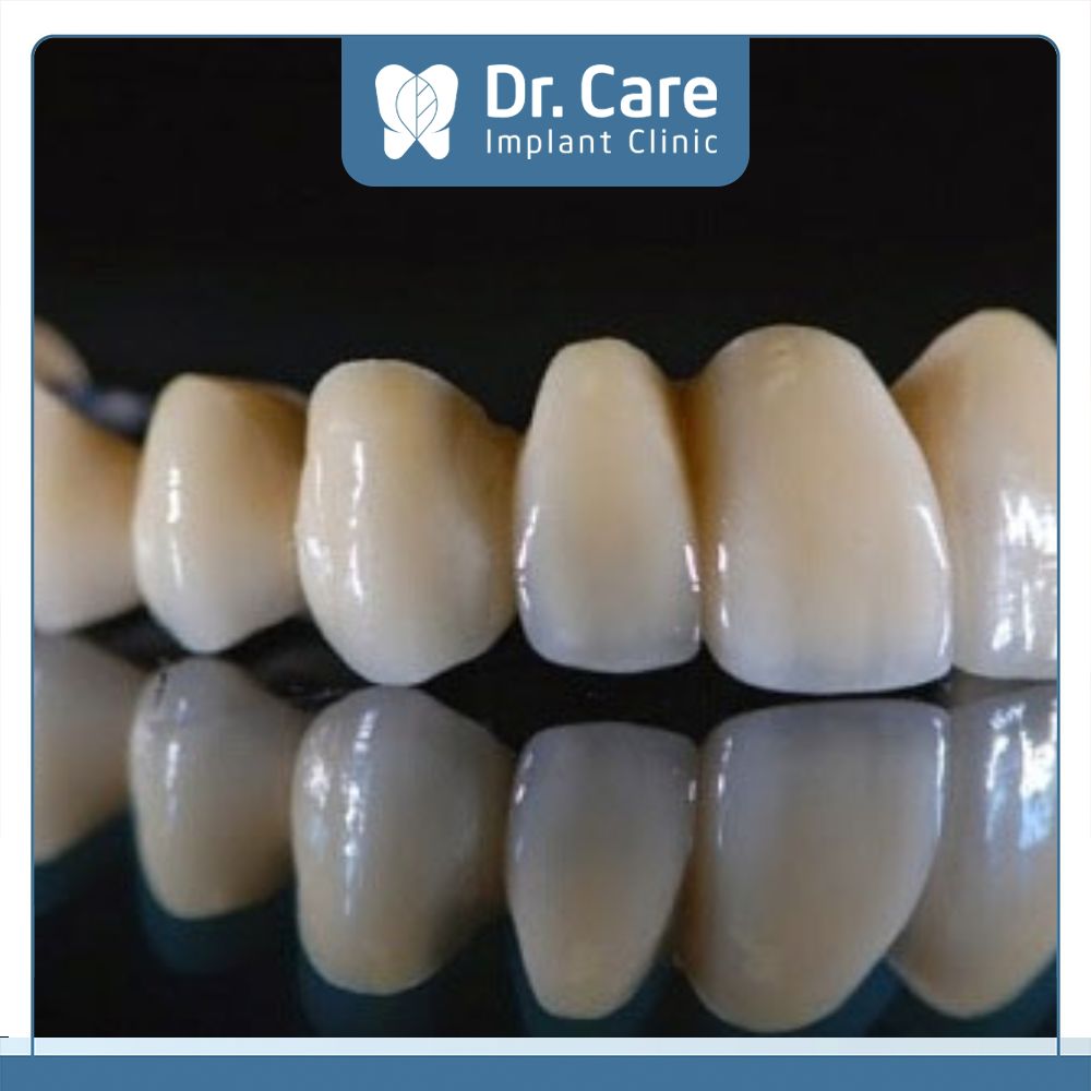 Răng sứ Ceramco có nhược điểm về độ thẩm mỹ kém, chưa đáp ứng tốt về độ phản quang, độ trong của răng