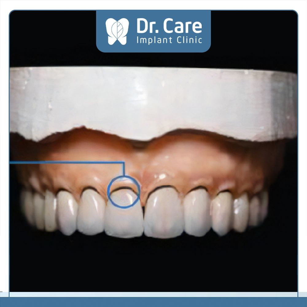 Lớp sườn răng Ceramco sau thời gian sử dụng dễ bị oxi hóa làm xuất hiện viền đen dưới chân răng gây mất thẩm mỹ 