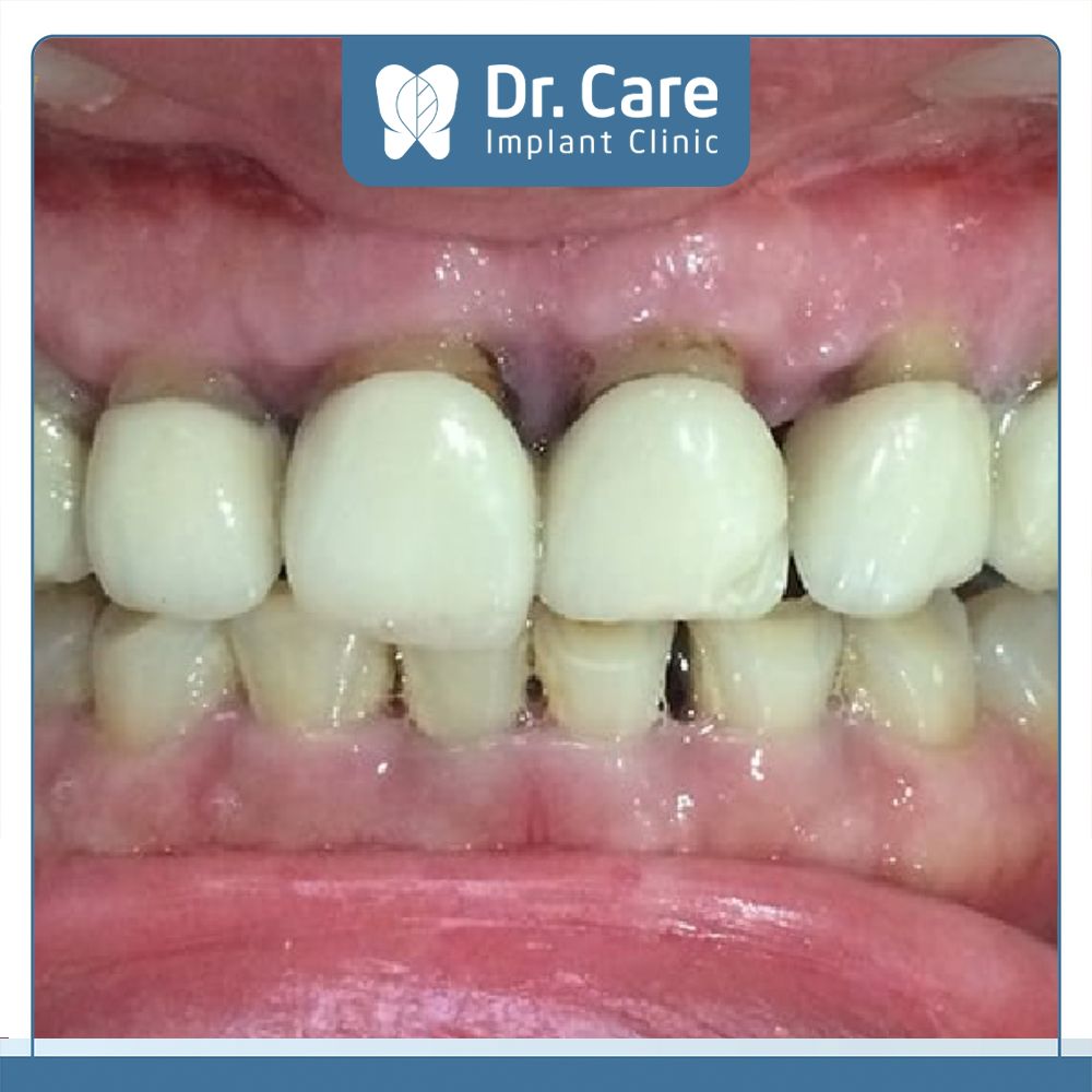 Tuổi thọ răng sứ Ceramco ngắn, trung bình từ 5-7 năm sẽ bị ngả màu, đen viền hay lộ bóng