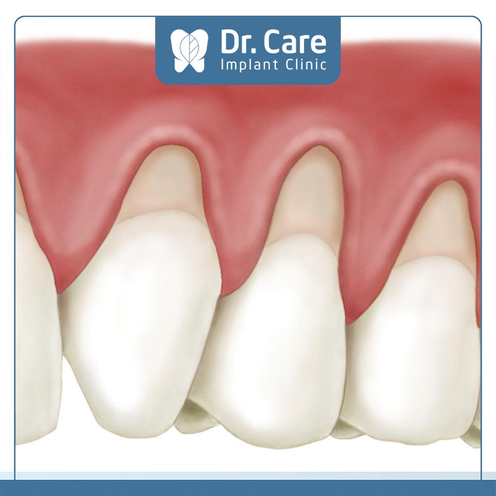 Tụt lợi là bệnh lý răng miệng dễ nhận biết khi thấy chân răng bị lộ nướu lúc đang co lại 