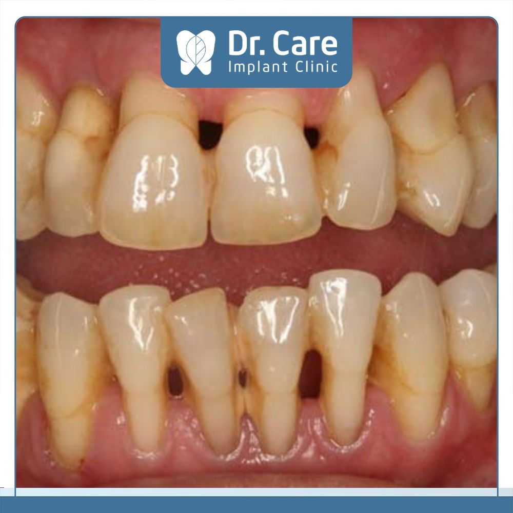 Khi răng mọc không đều, xô lệch sẽ gây áp lực nhiều lên phần nướu và xương răng gây tụt lợi